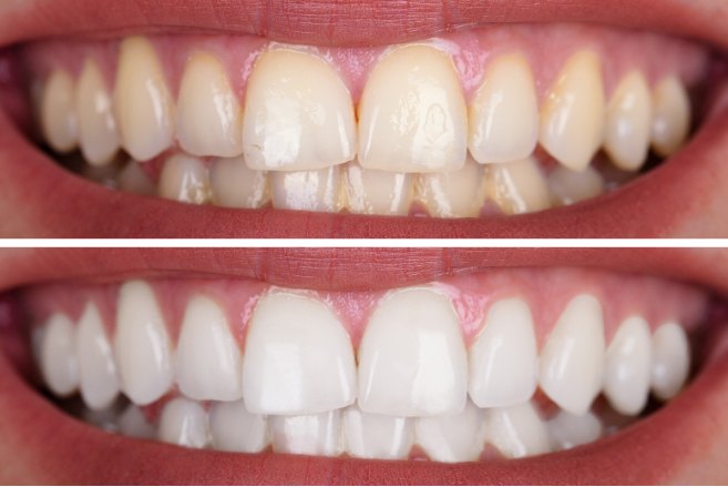 Before & After Teeth Whitening in Tucker, GA