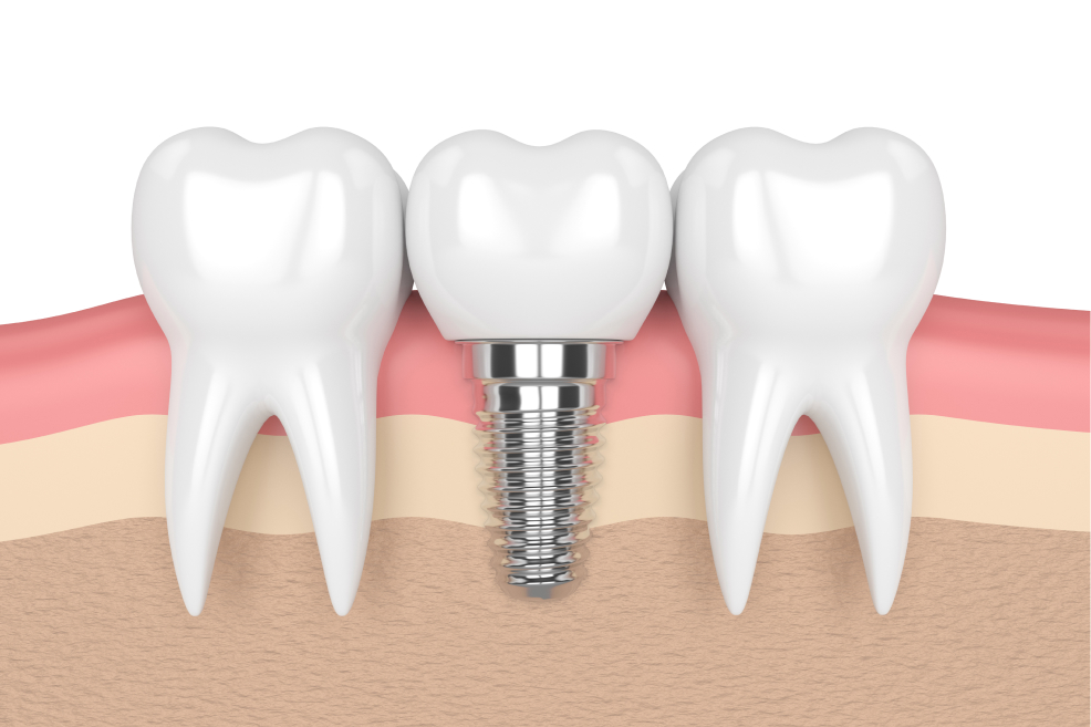 Dental implants cross-section in Tucker, GA